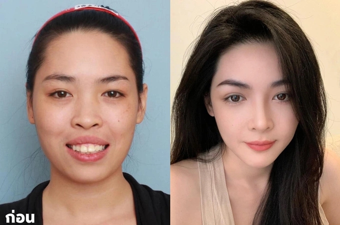 10 năm sau ca phẫu thuật "thay đầu" thành công nhất Việt Nam: Nữ chính được trao thân phận khác nhưng có 1 điều gây tiếc nuối- Ảnh 1.