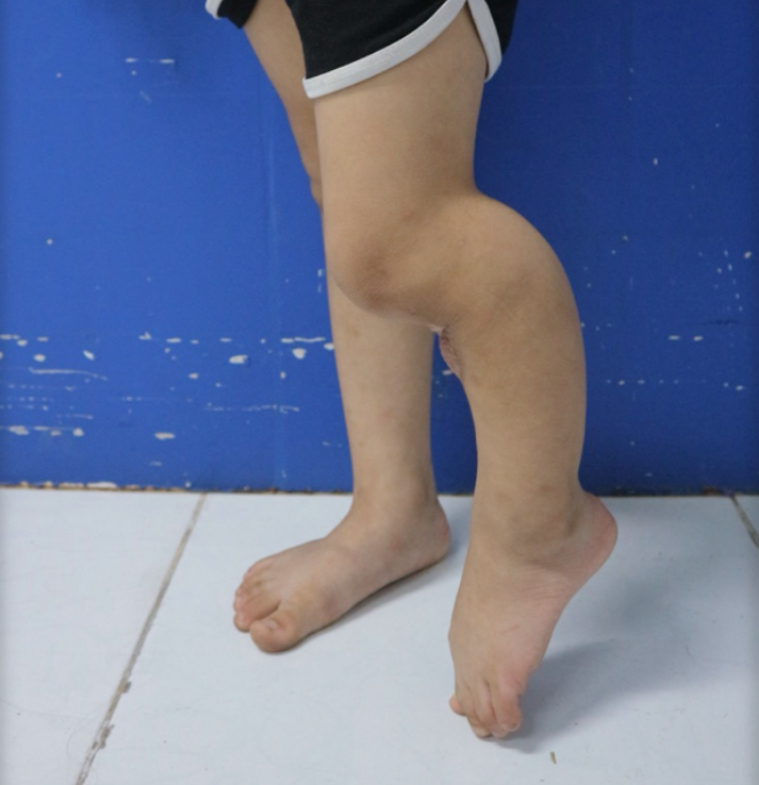 Bé gái 5 tuổi gãy xương đã được bó bột, bố mẹ vẫn khoét lỗ trên bột để đắp lá khiến xương không thể liền- Ảnh 1.