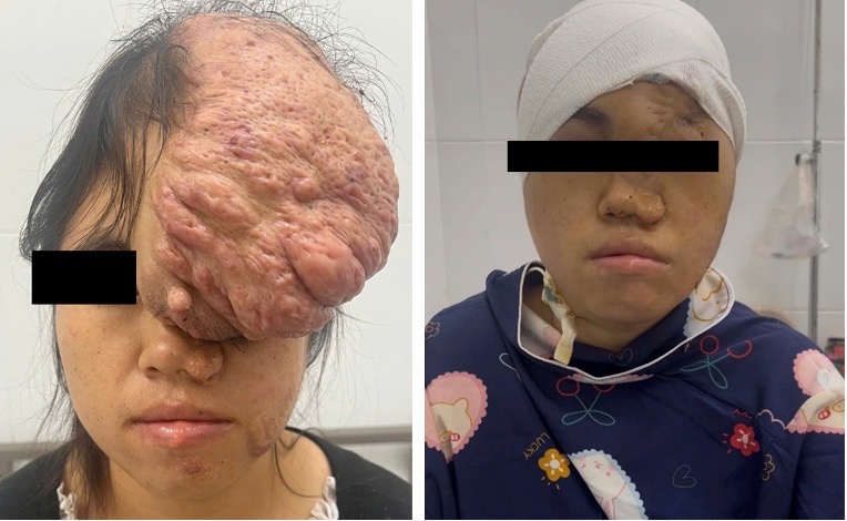 Ngỡ ngàng khuôn mặt cô gái sau 15 năm bị khối u khổng lồ đeo bám- Ảnh 1.