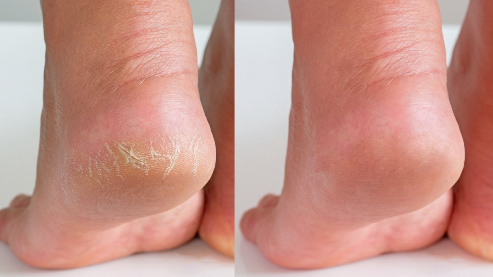 Muốn biết gan khoẻ hay yếu cứ nhìn vào chân sẽ rõ: Có 1 trong 5 dấu hiệu này nên đi khám ngay!- Ảnh 3.