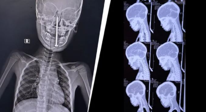 Phẫu thuật cho bé trai 7 tuổi, bác sĩ sốc nặng khi lấy ra "thứ đáng sợ"- Ảnh 1.