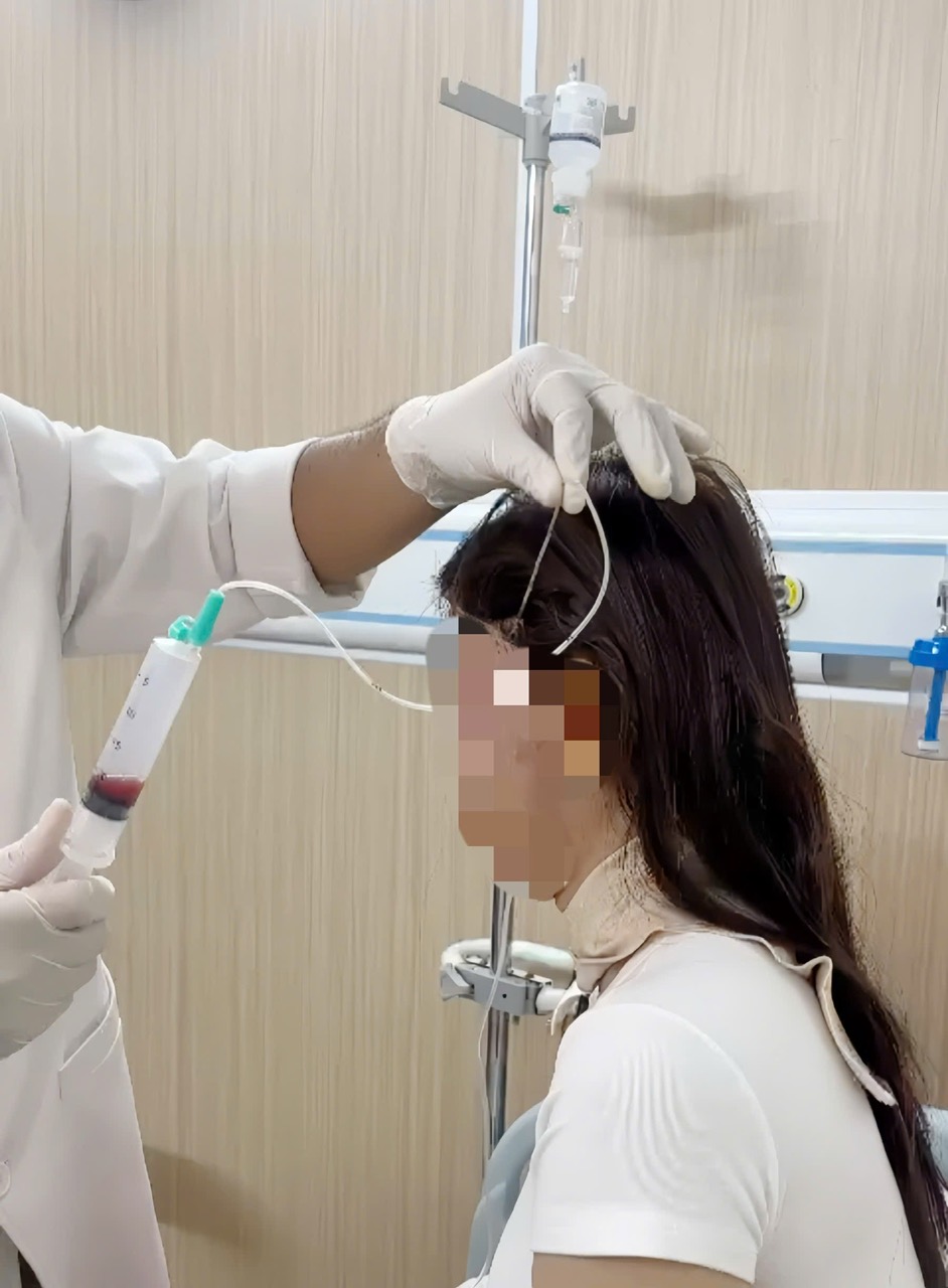 Sau một năm tiêm filler, người phụ nữ bị hoại tử mặt nặng nề- Ảnh 1.