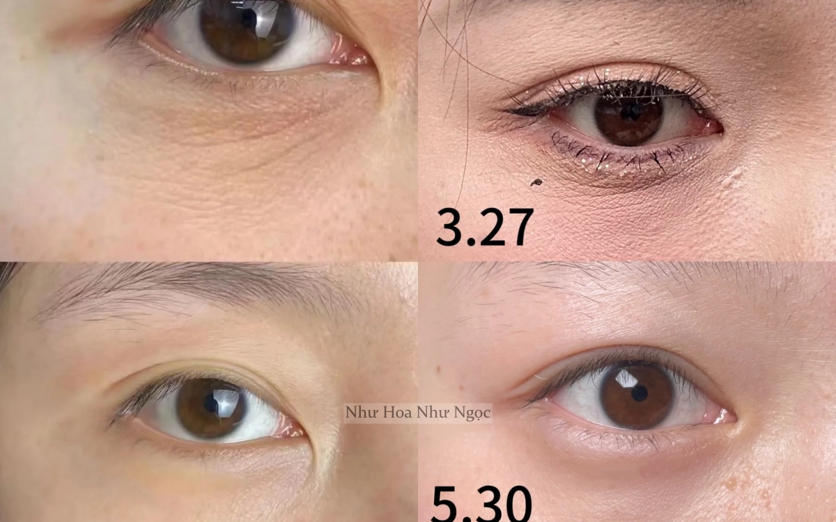 Cô nàng đắp cơm lên mắt, tưởng vô dụng nhưng bất ngờ khiến nếp nhăn giảm đi thấy rõ- Ảnh 2.
