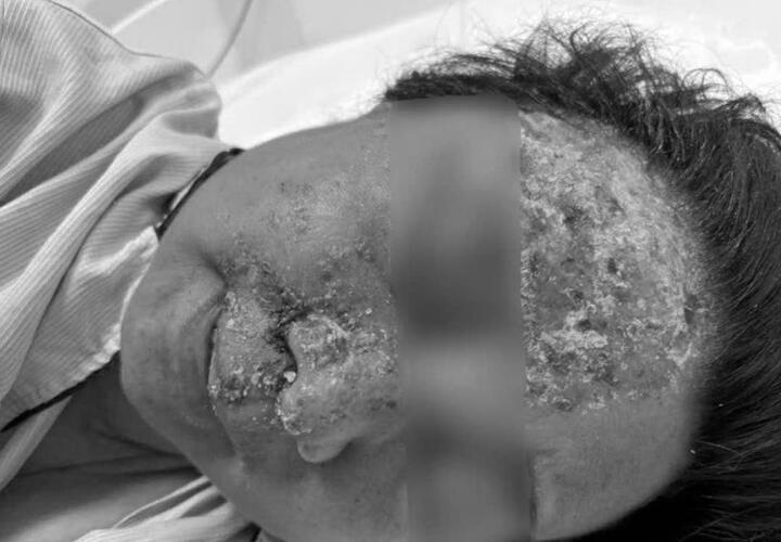 Nổi mụn nước tưởng dị ứng da, không ngờ nhiễm virus gây biến chứng nguy hiểm- Ảnh 1.
