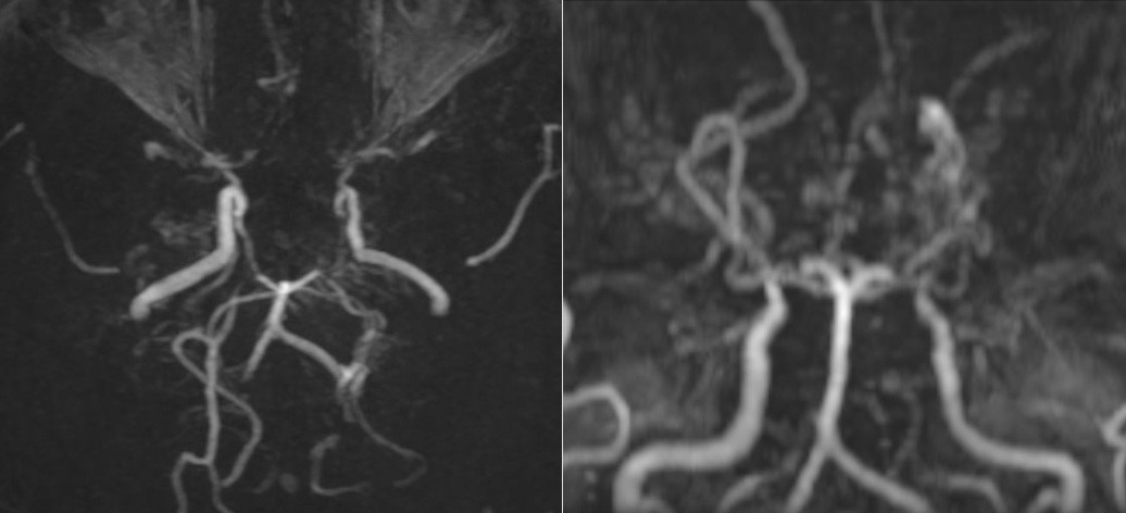 Hình ảnh MRI khiến bác sĩ bất ngờ: Mạch máu não bệnh nhân mờ như "khói thuốc"- Ảnh 1.