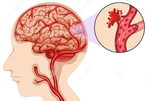 Nữ ca sĩ chia sẻ cơn ác mộng mang tên "vỡ mạch máu não ở tuổi 34": Bắt đầu là những cơn đau đầu "dữ dội như sét đánh"- Ảnh 3.