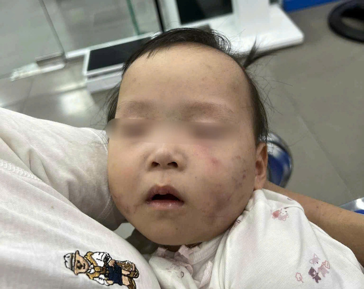 Làm rõ nguyên nhân bé gái bị bầm tím mặt khi gửi ở nhà trẻ Bắc Ninh- Ảnh 1. Làm rõ nguyên nhân bé gái bị bầm tím mặt khi gửi ở nhà trẻ Bắc Ninh- Ảnh 1.