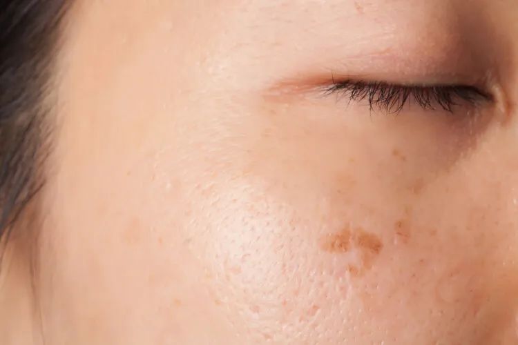 4 bất thường trên da là dấu hiệu của ung thư nhưng rất nhiều người KHÔNG HỀ HAY BIẾT!- Ảnh 1.