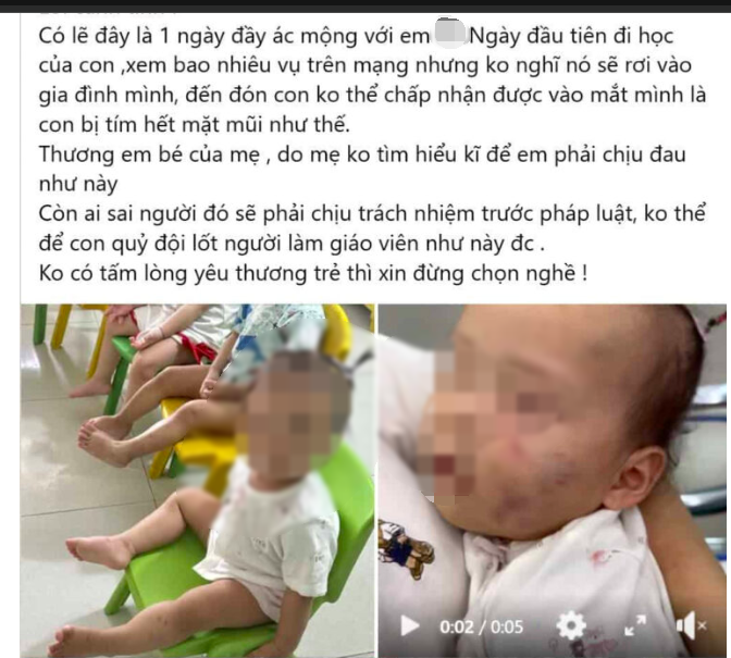 Bé gái bị bầm tím mặt sau khoảng 7 tiếng ở nhà trẻ tư thục: Tình trạng sức khoẻ hiện tại- Ảnh 1. Bé gái bị bầm tím mặt sau khoảng 7 tiếng ở nhà trẻ tư thục: Tình trạng sức khoẻ hiện tại- Ảnh 1.