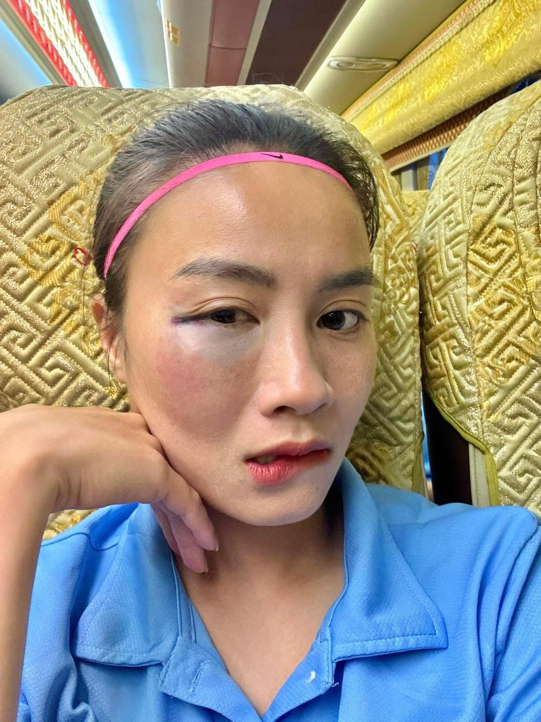 Hotgirl bóng đá Hoàng Thị Loan để lộ vùng mắt sưng vù sau pha va chạm trên sân bóng khiến fan cực xót- Ảnh 2.