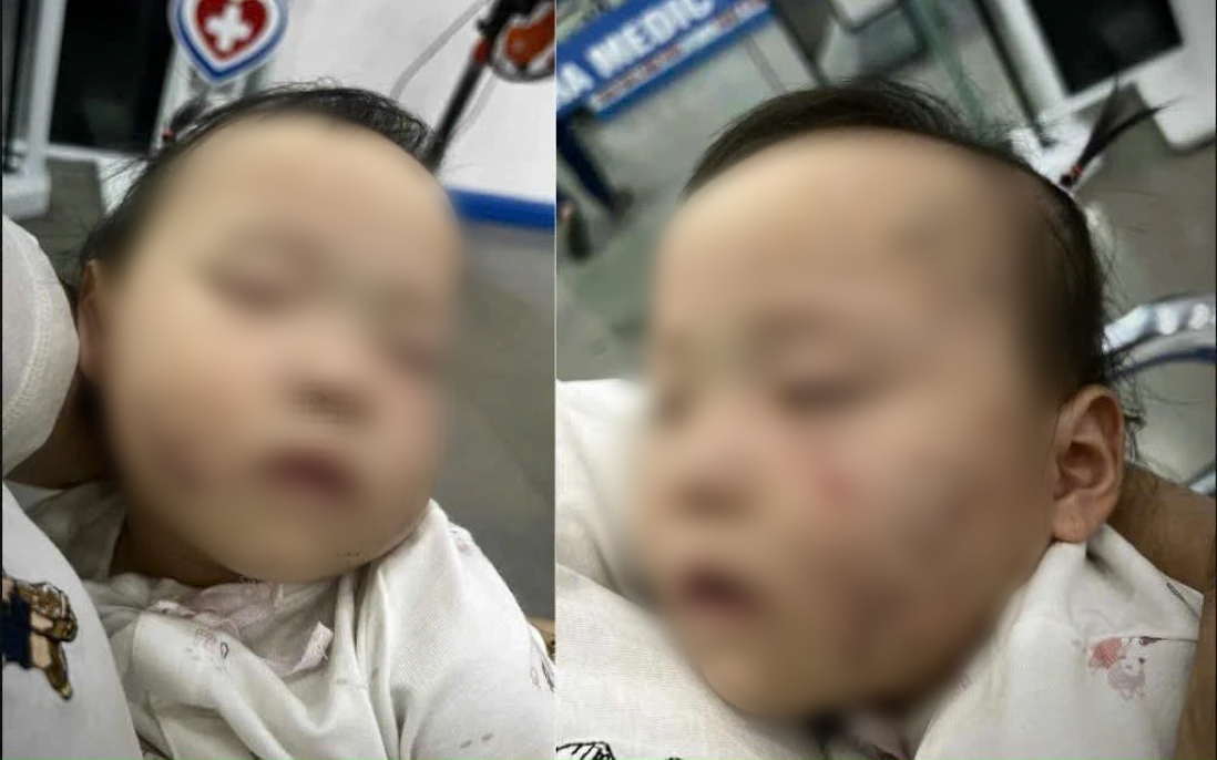 Vụ bé gái bầm tím mặt, có vết răng cắn sau khi đi học mầm non tư thục: Thông tin bất ngờ về cô giáo- Ảnh 1.