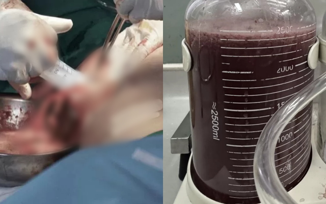 Rùng mình: Người phụ nữ TP.HCM bị áp-xe ăn mòn sau mũi tiêm filler nâng mông, bác sĩ sốc khi hút ra 2,5 lít dịch mô hoại tử