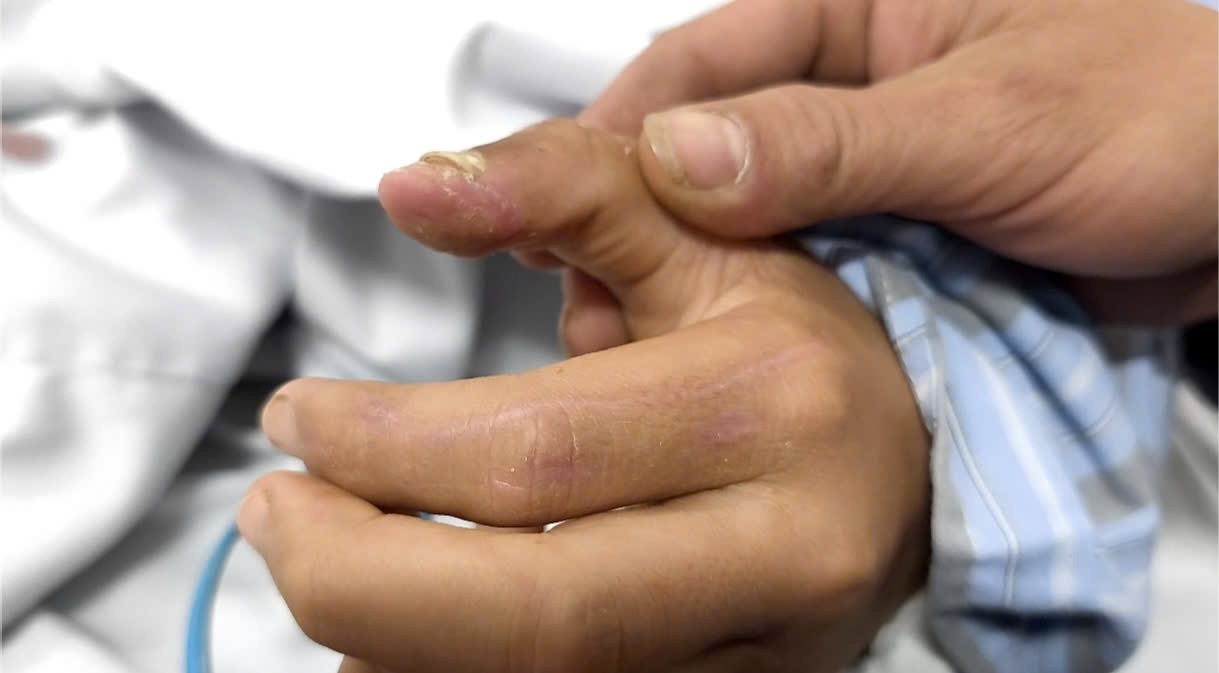 Kh&ocirc;ng ti&ecirc;m ph&ograve;ng sau khi bị ch&oacute; cắn, b&eacute; trai bị l&ecirc;n cơn dại- Ảnh 1.