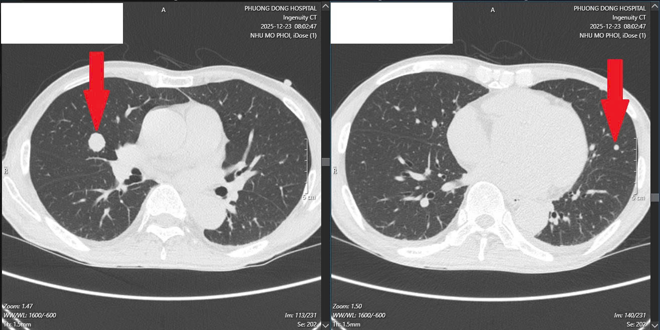 Ung thư lan khắp gan, phổi sau 6 tháng uống chanh muối để tự “chữa lành”- Ảnh 2. Ung thư lan khắp gan, phổi sau 6 tháng uống chanh muối để tự “chữa lành”- Ảnh 2.