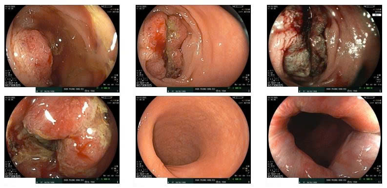 Ung thư lan khắp gan, phổi sau 6 tháng uống chanh muối để tự “chữa lành”- Ảnh 1. Ung thư lan khắp gan, phổi sau 6 tháng uống chanh muối để tự “chữa lành”- Ảnh 1.