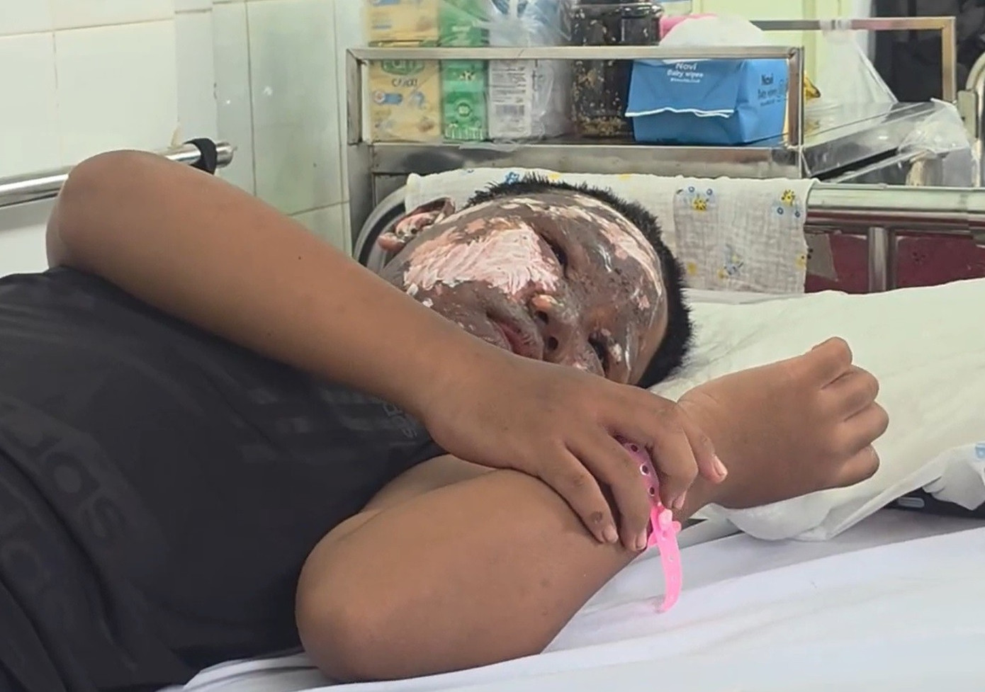 Chơi ph&aacute;o nổ, b&eacute; trai bị tai nạn ch&aacute;y đen khu&ocirc;n mặt- Ảnh 1.