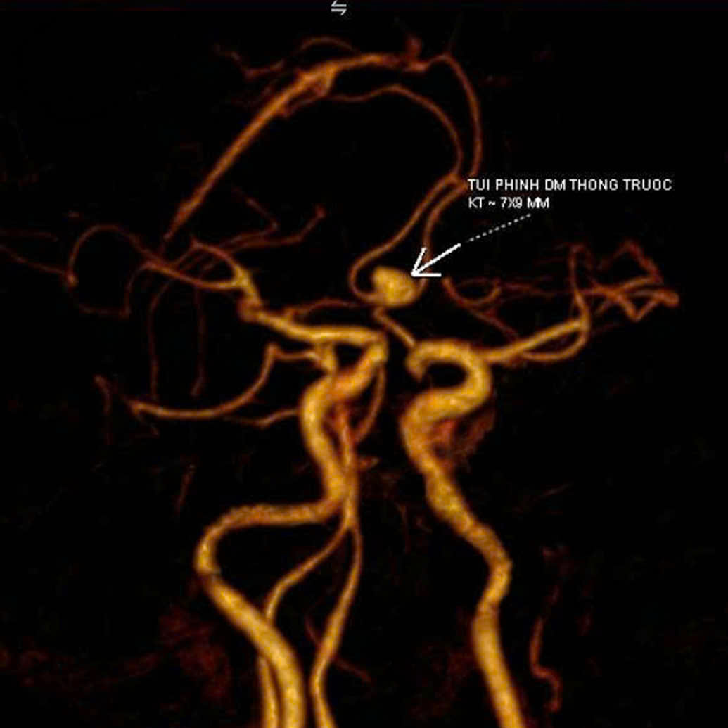 Đau đầu k&eacute;o d&agrave;i, c&ocirc; g&aacute;i H&agrave; Nội đi kh&aacute;m ph&aacute;t hiện ph&igrave;nh mạch n&atilde;o, su&yacute;t đột quỵ- Ảnh 1.