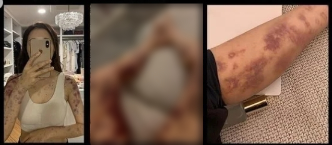 Sao nữ xinh như tiên tỉnh dậy hoảng loạn thấy toàn thân bầm tím sau khi tiêm thuốc bổ tại bệnh viện- Ảnh 2. Sao nữ xinh như tiên tỉnh dậy hoảng loạn thấy toàn thân bầm tím sau khi tiêm thuốc bổ tại bệnh viện- Ảnh 2.