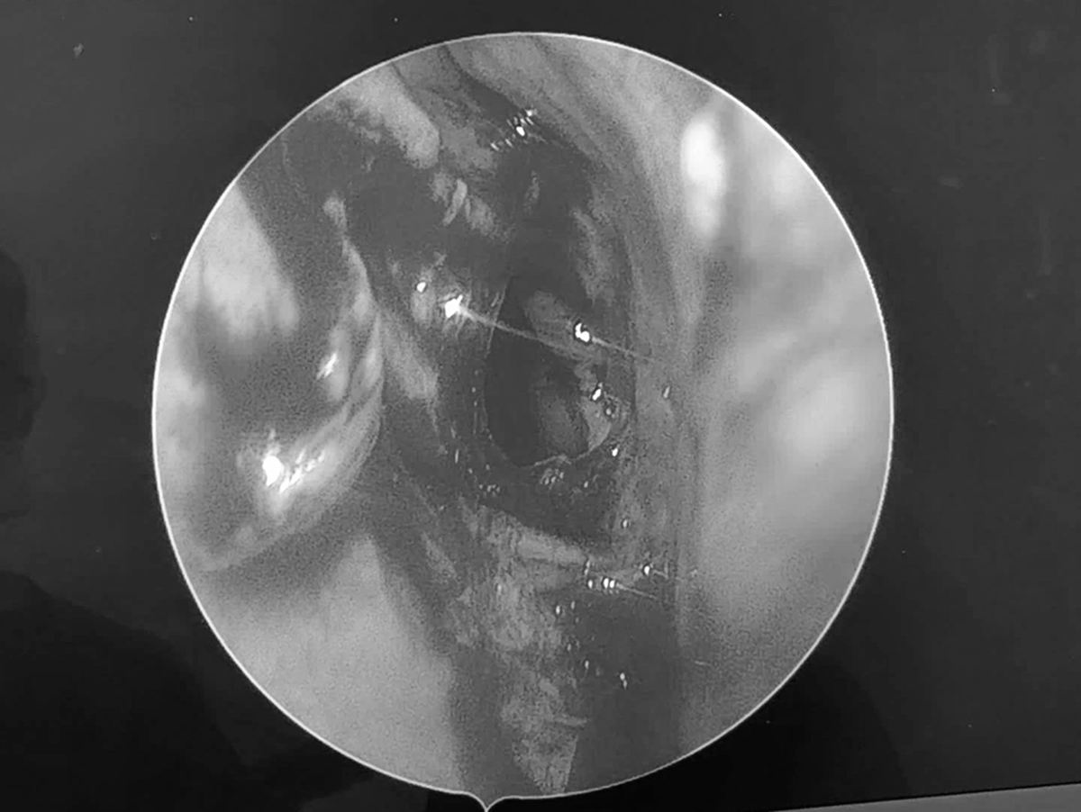 Đi kh&aacute;m, người đ&agrave;n &ocirc;ng sốc nặng khi b&aacute;c sĩ thấy thứ "đ&aacute;ng sợ" trong mũi m&igrave;nh- Ảnh 1.