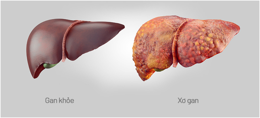 Si&ecirc;u &acirc;m ph&aacute;t hiện nhiều người trẻ gan th&ocirc; x&ugrave; x&igrave;, nguy&ecirc;n nh&acirc;n v&igrave; đ&acirc;u?- Ảnh 1.