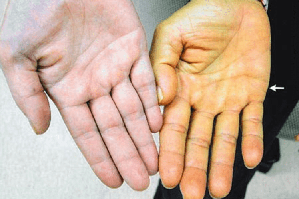 Si&ecirc;u &acirc;m ph&aacute;t hiện nhiều người trẻ gan th&ocirc; x&ugrave; x&igrave;, nguy&ecirc;n nh&acirc;n v&igrave; đ&acirc;u?- Ảnh 3.