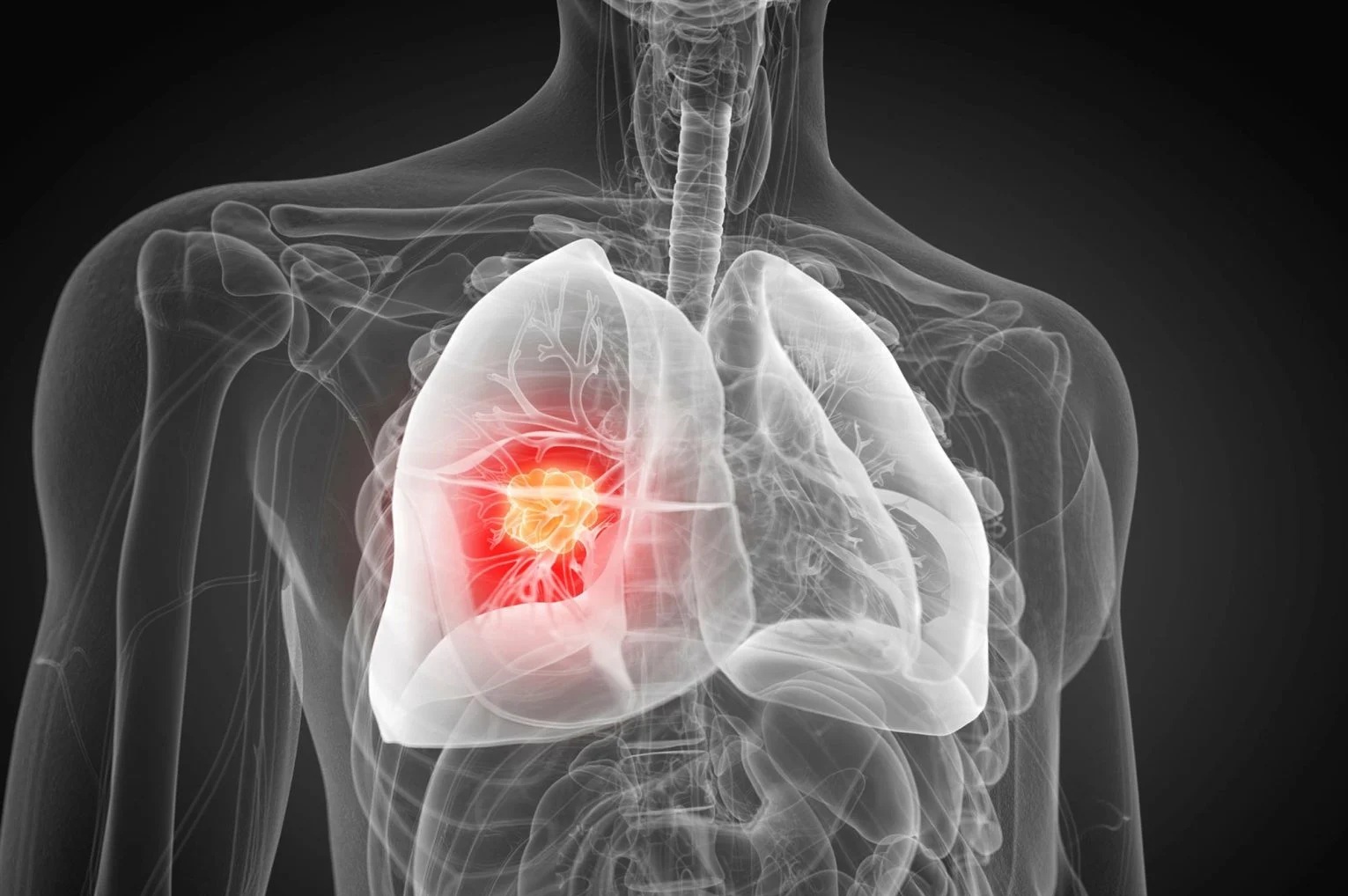 Ph&aacute;t hiện nguy&ecirc;n nh&acirc;n g&acirc;y ung thư phổi chưa từng biết- Ảnh 1.