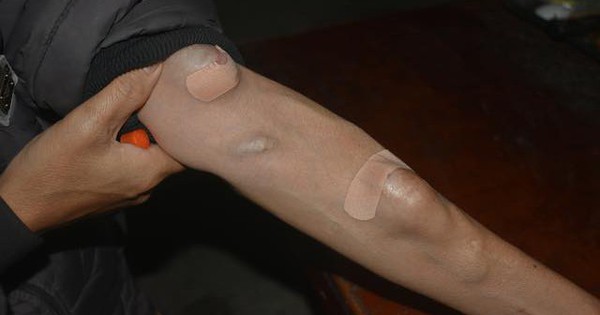 C&aacute;nh tay của người chạy thận h&oacute;a ra tr&ocirc;ng thế n&agrave;y: 1 vũ c&ocirc;ng chuy&ecirc;n mặc &aacute;o d&agrave;i tay 1 b&ecirc;n đ&atilde; 