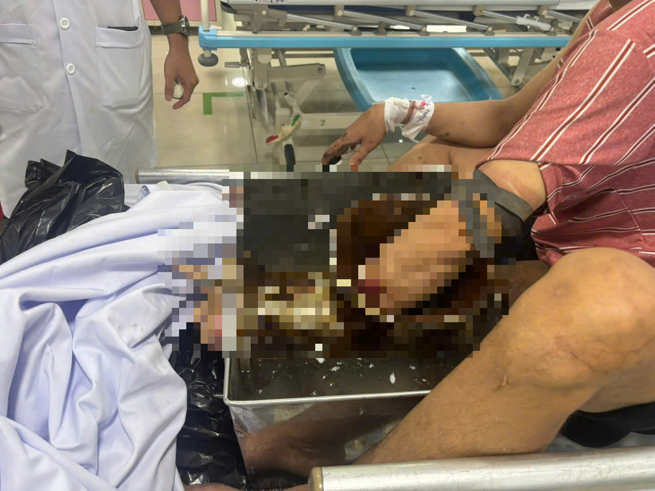 Người đàn ông vác cả máy xay thịt đến bệnh viện cấp cứu- Ảnh 1.