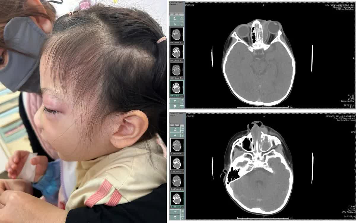 &Aacute;p xe ổ mắt do vi&ecirc;m xoang kh&aacute;ng kh&aacute;ng sinh- Ảnh 1.