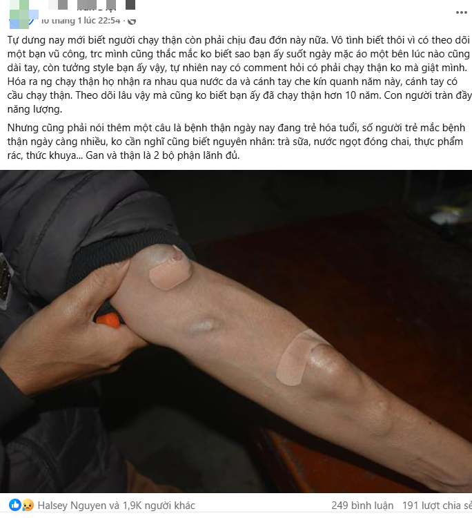 C&aacute;nh tay của người chạy thận h&oacute;a ra tr&ocirc;ng thế n&agrave;y: 1 vũ c&ocirc;ng chuy&ecirc;n mặc &aacute;o d&agrave;i tay 1 b&ecirc;n đ&atilde; "thức tỉnh" những ai kh&ocirc;ng biết- Ảnh 1.