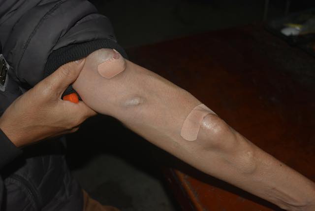 C&aacute;nh tay của người chạy thận h&oacute;a ra tr&ocirc;ng thế n&agrave;y: 1 vũ c&ocirc;ng chuy&ecirc;n mặc &aacute;o d&agrave;i tay 1 b&ecirc;n đ&atilde; "thức tỉnh" những ai kh&ocirc;ng biết- Ảnh 3.