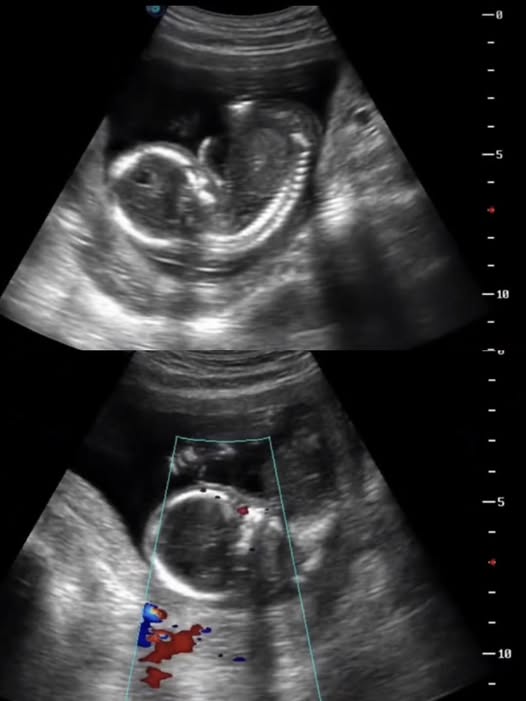 Thai phụ mất con sau khi bị buộc về qu&ecirc; l&agrave;m cỗ: C&acirc;u chuyện khiến cộng đồng x&oacute;t xa v&agrave; cảnh b&aacute;o nguy cơ cho mẹ bầu- Ảnh 1.