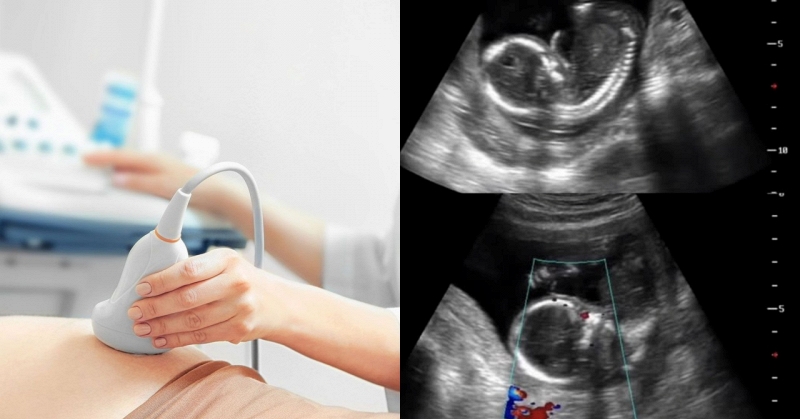 Thai phụ mất con sau khi bị buộc về qu&ecirc; l&agrave;m cỗ: C&acirc;u chuyện khiến cộng đồng x&oacute;t xa v&agrave; cảnh b&aacute;o nguy cơ cho mẹ bầu