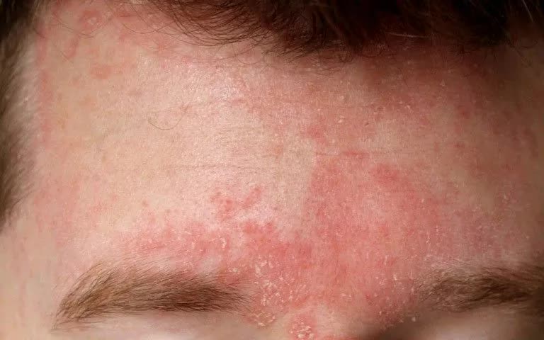 Những bệnh da thường gặp trong m&ugrave;a lạnh- Ảnh 1.