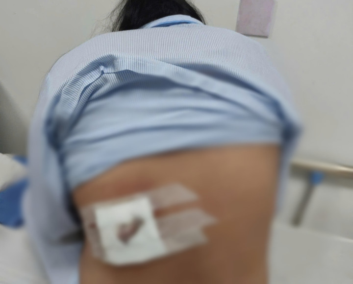 Đắp l&aacute; điều trị mụn lưng, người phụ nữ ở Quảng Trị bị hoại tử- Ảnh 1.