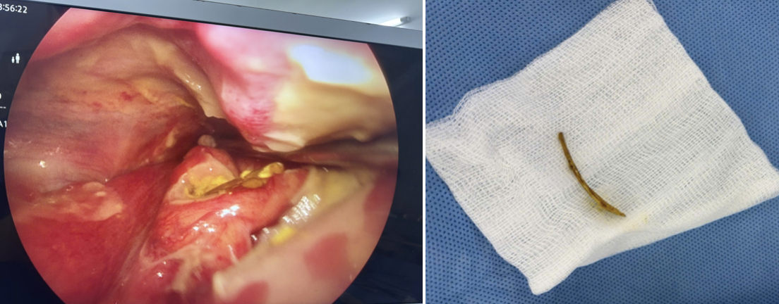 Ngậm vi&ecirc;n sủi C để chữa h&oacute;c xương c&aacute;, người phụ nữ nguy kịch- Ảnh 1.