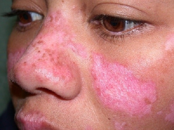 C&ocirc; g&aacute;i Huế đột ngột qua đời trước ng&agrave;y cưới nửa th&aacute;ng do mắc bệnh lupus ban đỏ: Cảnh b&aacute;o 1 nh&oacute;m phụ nữ nguy cơ cao mắc bệnh