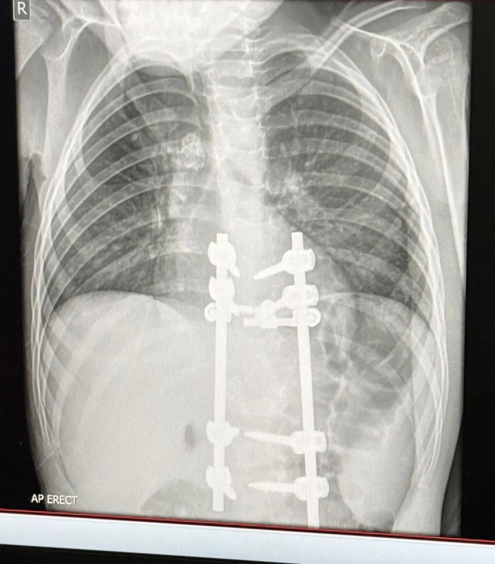 Mẹ ph&aacute;t hiện căn bệnh đ&aacute;ng sợ của con trai nhờ quan s&aacute;t d&aacute;ng đi bất thường- Ảnh 2.