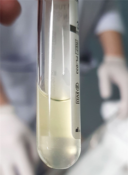 Nhiều bệnh nh&acirc;n vi&ecirc;m m&agrave;ng n&atilde;o do n&atilde;o m&ocirc; cầu diễn biến nặng- Ảnh 1.