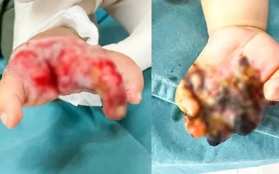 Cứu b&agrave;n tay hoại tử do m&aacute;y tuốt l&uacute;a cho bệnh nhi 8 th&aacute;ng tuổi- Ảnh 1.