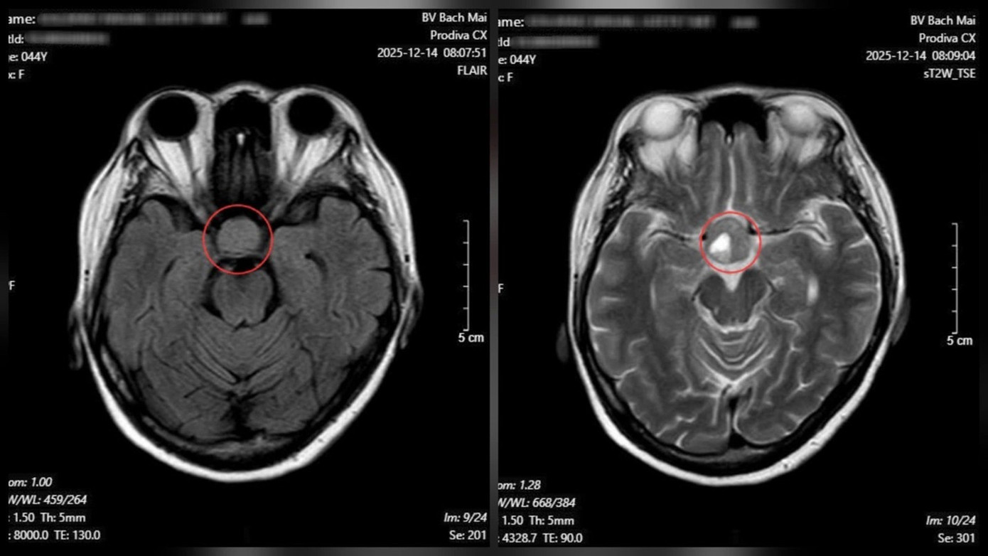 Nh&igrave;n mờ k&eacute;o d&agrave;i, người đ&agrave;n &ocirc;ng ph&aacute;t hiện bệnh l&iacute; nguy hiểm- Ảnh 2.