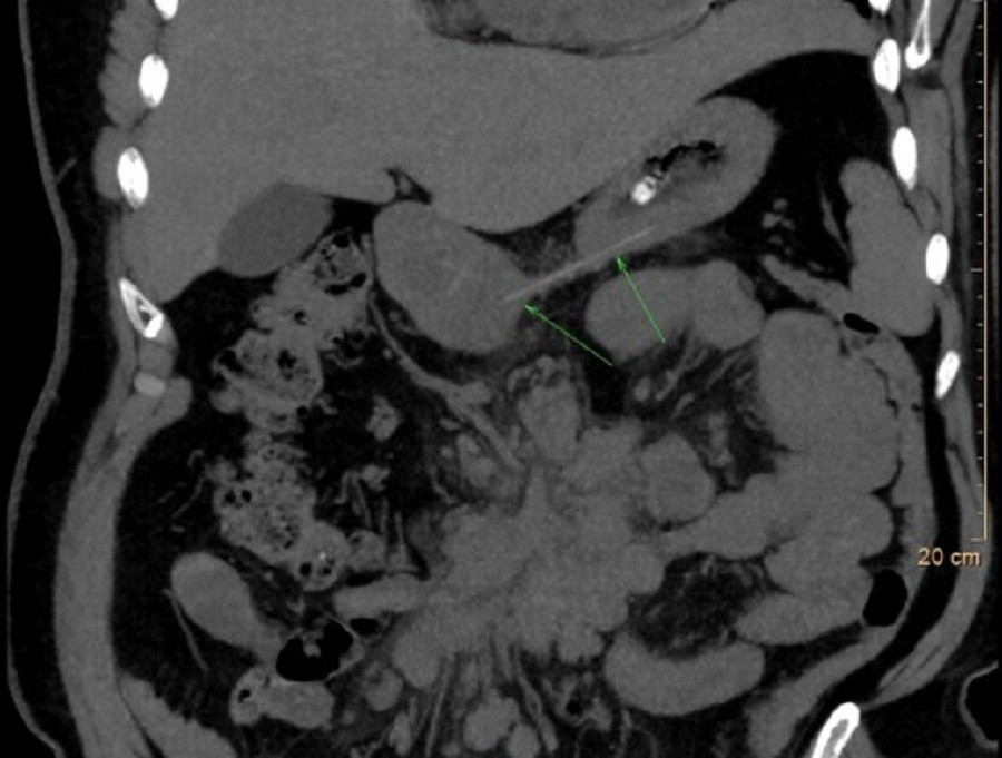 Những 'mẹo' chữa h&oacute;c xương phản khoa học, c&oacute; thể g&acirc;y chết người- Ảnh 2.