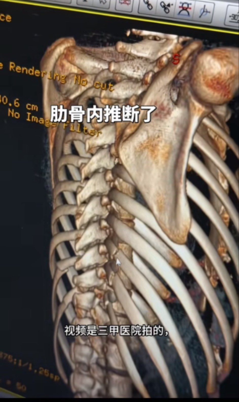 Xu hướng bẻ xương sườn để c&oacute; v&ograve;ng eo con kiến- Ảnh 3.