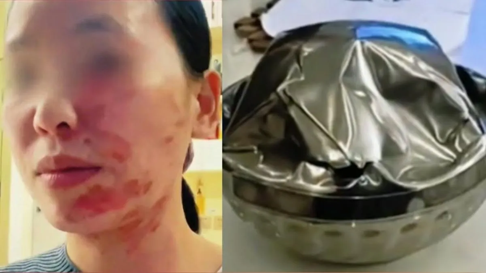 Chiếc bát bất ngờ phát nổ khiến người phụ nữ bỏng toàn thân: 3 loại bát nên cân nhắc khi đựng đồ nóng kẻo tự hại thân- Ảnh 1.
