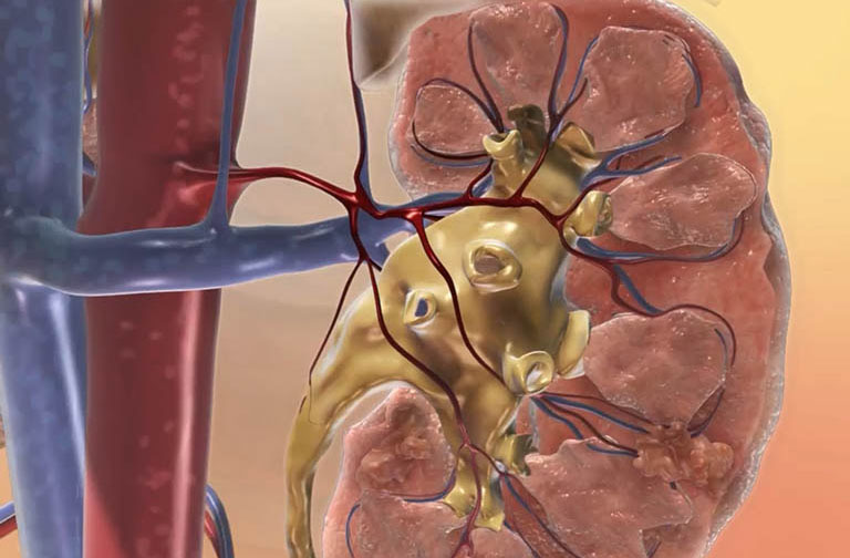 Nữ sinh năm nhất mắc suy thận giai đoạn cuối, phải chạy thận cả đời: B&aacute;c sĩ cảnh b&aacute;o thứ m&agrave; ai cũng hay bỏ qua- Ảnh 1.