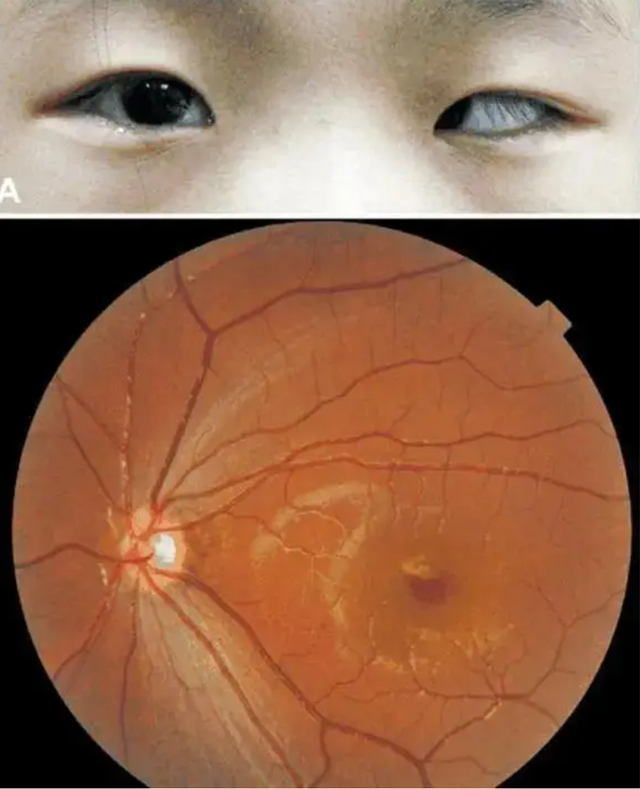 Bé 5 tuổi chơi game trong thời gian dài, tròng đen dần biến mất, bác sĩ cảnh báo rất khó phục hồi- Ảnh 3.