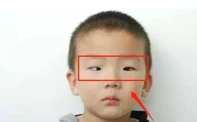 Bé 5 tuổi chơi game trong thời gian dài, tròng đen dần biến mất, bác sĩ cảnh báo rất khó phục hồi- Ảnh 2.