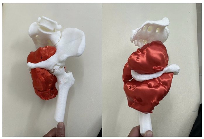 Đau háng kéo dài, người đàn ông bị phát hiện ung thư xương ác tính- Ảnh 2.