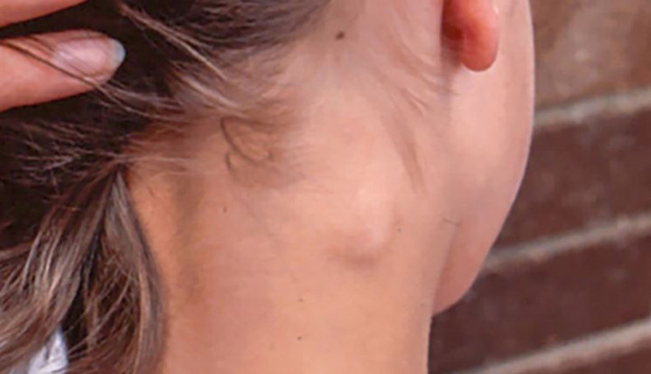 3 bất thường ở cổ cảnh b&aacute;o ung thư, h&atilde;y đi kh&aacute;m b&aacute;c sĩ ngay lập tức- Ảnh 1.