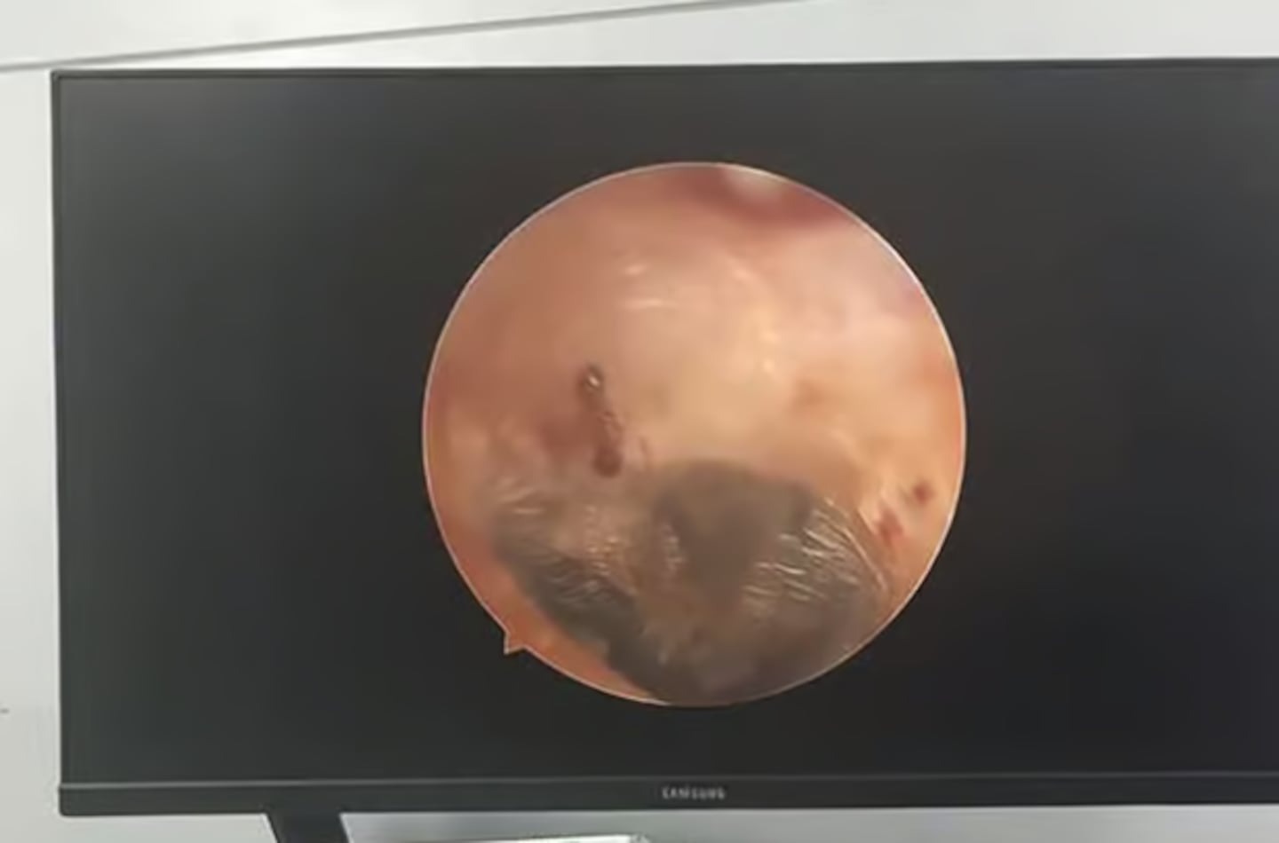 Nghe thấy &acirc;m thanh lạ trong tai, người phụ nữ đi kh&aacute;m th&igrave; sốc nặng- Ảnh 1.